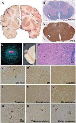 Multiple sclerosis in LRRK2 G2019S Parkinson’s disease and isolated nigral degeneration in a homozygous variant carrier